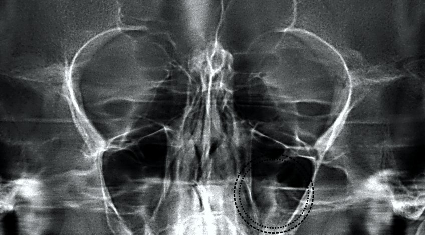 Radiografía de Cavidades Perinasales
